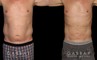 Male patients with liposuction results for full abdominal contouring. Patient healed well with minimal visible scarring and a flat stomach as seen in the profile view.