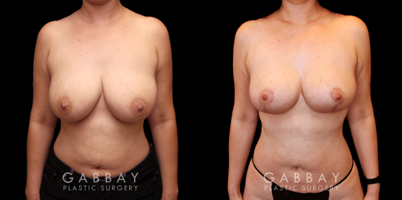 Procedures Depicted:  Breast lift and auto aug