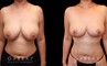 Procedures Depicted:  Breast lift and auto aug