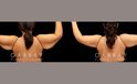 Patient 03 Front View Arm Lift with Lipo Gabbay Plastic Surgery