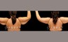 Patient 03 Front View Arm Lift with Lipo Gabbay Plastic Surgery