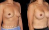 Silicone implants used to increase breast volume while keeping a natural shape. Patient healed well with no complications.