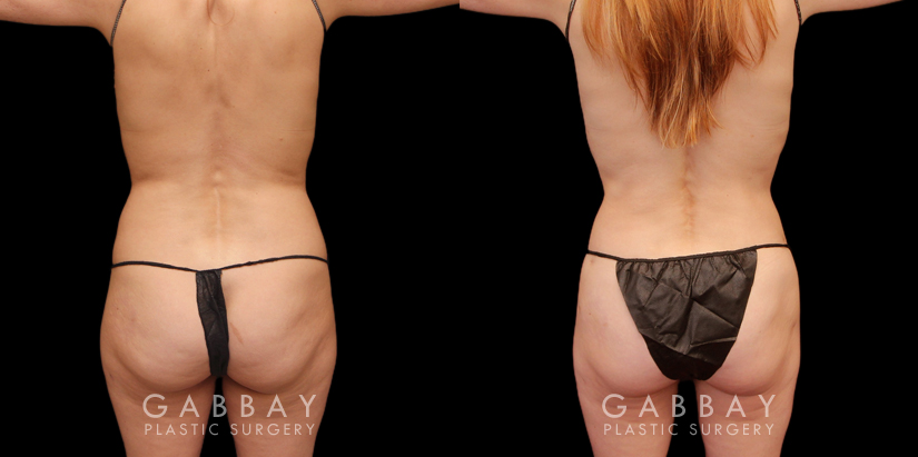 Procedures Depicted:  Mini tummy tuck and lipo to waist