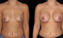 Silicone implants used to increase breast size in female patient in her 30s. Boost ot breast volume resulted in a more feminine contour from each before-and-after photo angle.