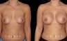 Silicone implants used to increase breast size in female patient in her 30s. Boost ot breast volume resulted in a more feminine contour from each before-and-after photo angle.