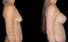 Silicone implants results for female patient in her 30s. Smaller, loose breasts were augmented to a firmer, taut volume with minimal overhang for improved comfort.