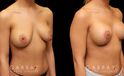 Procedures Depicted:  Breast Augmentation w/ Mastopexy – Silicone