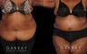 Patient photos showing before and after abdominoplasty procedure. Before surgery, the patient had significant banding and loose skin over the abdomen. Following liposuction to multiple areas combined with surgical excision of excess skin, the final result is a tighter, firmer look.