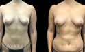 Patient 09 Front View Breast Fat Grafting Gabbay Plastic Surgery