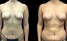 Patient 09 Front View Breast Fat Grafting Gabbay Plastic Surgery
