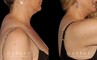Patient 01 Right Side View Liposuction to Abdomen, Waist, Tailbone & Arms Gabbay Plastic Surgery