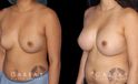 Following a smooth recovery, the patient’s silicone implants settle well to produce a round breast shape with increased volume. The breasts sit comfortable without the position being altered.