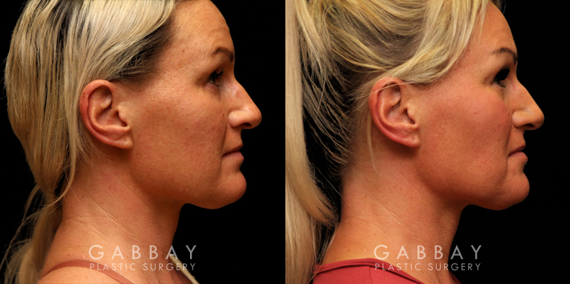 Procedures Depicted:  Buccal Fat Pad Removal