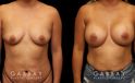Before-and-after photos for female patient with breast augmentation. Classic results show improved size and volume of breasts with enhanced roundness from each angle.
