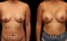 Before-and-after photos for female patient with breast augmentation. Classic results show improved size and volume of breasts with enhanced roundness from each angle.
