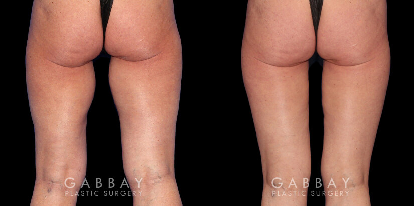 Patient 01 Front View Thigh Lift Gabbay Plastic Surgery