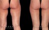 Patient 01 Front View Thigh Lift Gabbay Plastic Surgery