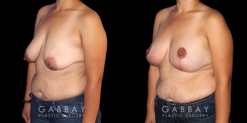Procedures Depicted:  Breast Augmentation – Silicone, Mastopexy