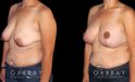 Procedures Depicted:  Breast Augmentation – Silicone, Mastopexy