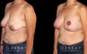 Procedures Depicted:  Breast Augmentation – Silicone, Mastopexy