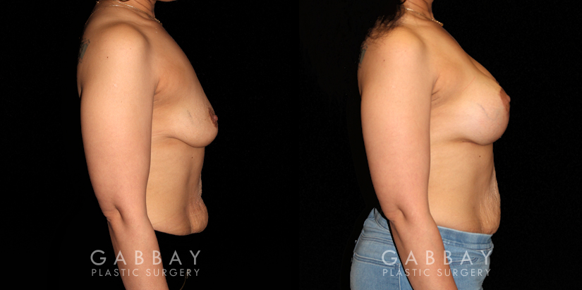 Procedures Depicted:  Breast Augmentation – Silicone & Lift