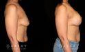 Procedures Depicted:  Breast Augmentation – Silicone & Lift
