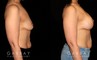 Procedures Depicted:  Breast Augmentation – Silicone & Lift