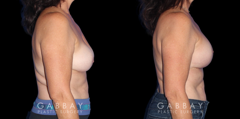 Procedures Depicted:  R&R + Breast Lift