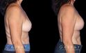 Procedures Depicted:  R&R + Breast Lift