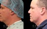 Male neck liposuction results for mid 50s man. Photos demonstrate the contour around the jawline for an overall enhanced masculine jawline contour. Though subtle and refined, the results are noticeable from multiple angles.