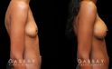 Patient before-and-after photos for breast augmentation with silicone implants. Patient increased cup size while maintaining a natural, balanced look to the breasts.