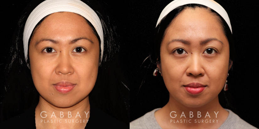 Procedures Depicted:  Buccal Fat Pad Removal