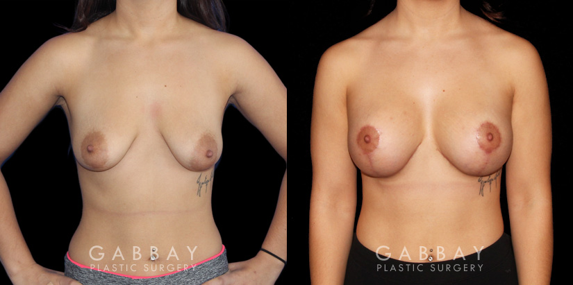 Procedures Depicted:  Breast Augmentation w/ Mastopexy – Silicone