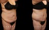 Patient before and after tummy tuck combined with breast lift. The tightening of the abdomen along with the repositioning of the breasts creates a more balanced aesthetic with tighter skin.
