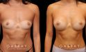 Patient after breast augmentation with silicone implants. Not the round and perky position of the breasts following recovery and dissipation of swelling.