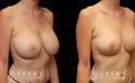 This patient had a previous breast augmentation with implants that she felt were far too big for her frame and not the look that she wanted. She had requested that her prior surgeon perform a breast lift because she had extreme breast droop or ptosis. Her surgeon chose to simply put in a large breast implant instead, and left her very unhappy. She came to Gabbay Plastic Surgery for a breast implant, revision and lift. Her implants were exchanged for smaller silicone implants, the pockets were closed into an appropriate size, and she underwent a breast lift to reduce the droop. Galaflex mesh was also used to keep her breasts lifted overtime. Over time, her scars almost completely disappeared, and she was extremely happy with her new look.