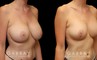 This patient had a previous breast augmentation with implants that she felt were far too big for her frame and not the look that she wanted. She had requested that her prior surgeon perform a breast lift because she had extreme breast droop or ptosis. Her surgeon chose to simply put in a large breast implant instead, and left her very unhappy. She came to Gabbay Plastic Surgery for a breast implant, revision and lift. Her implants were exchanged for smaller silicone implants, the pockets were closed into an appropriate size, and she underwent a breast lift to reduce the droop. Galaflex mesh was also used to keep her breasts lifted overtime. Over time, her scars almost completely disappeared, and she was extremely happy with her new look.