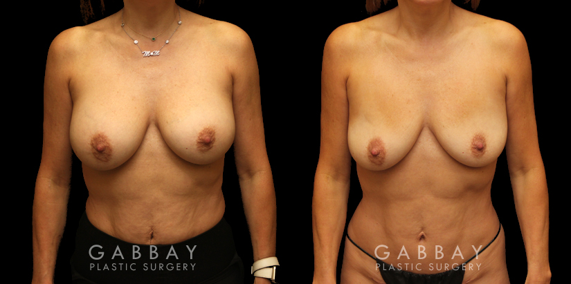 Procedures Depicted:  Mini tummy tuck and lipo to waist
