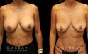 Procedures Depicted:  Mini tummy tuck and lipo to waist