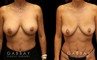 Procedures Depicted:  Mini tummy tuck and lipo to waist