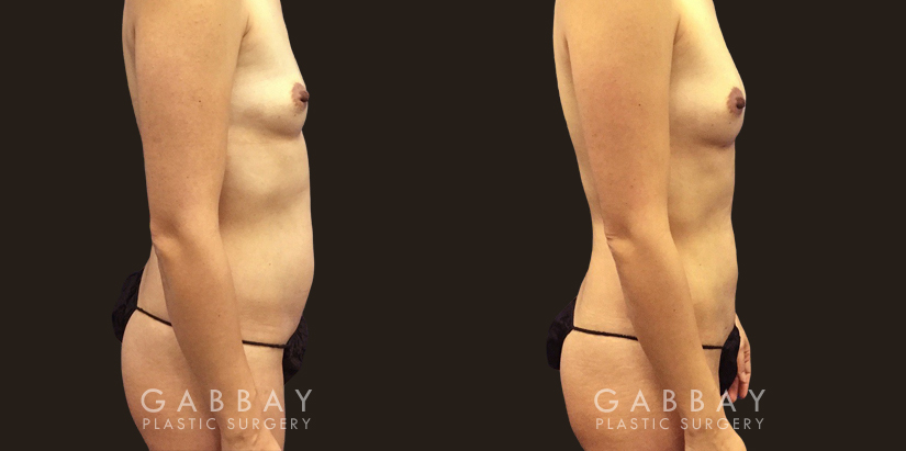 Procedures Depicted:  Breast Augmentation – Silicone Patient sought to remove final stubborn pockets of belly fat, restoring a more youthful figure and enhancing her natural figure.