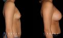 Breast augmentation patient results with silicone implants after fully healed. Breast size increased by multiple cups while keeping a natural balance between breast size and the patient’s body type.