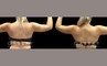 Patient 16 Back View Lipo Arms Gabbay Plastic Surgery