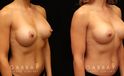 Patient 01 3/4th Right Side View Breast Revision Gabbay Plastic Surgery
