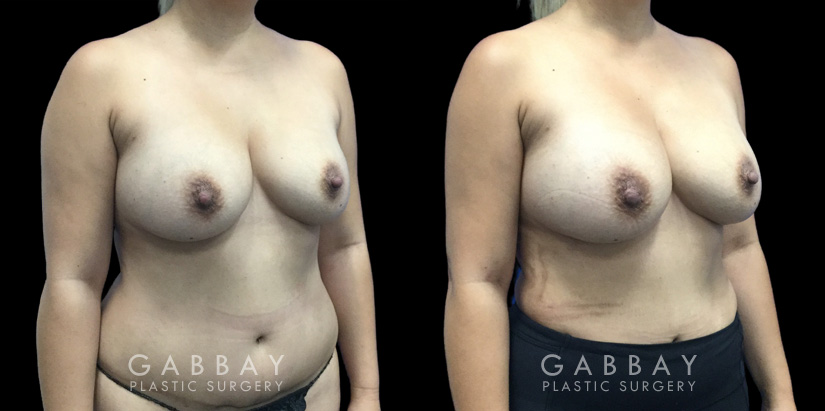 Patient 13 Front View Breast Fat Grafting Gabbay Plastic Surgery