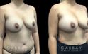 Patient 13 Front View Breast Fat Grafting Gabbay Plastic Surgery