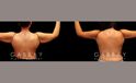 Patient 02 Back View Arm Lift Gabbay Plastic Surgery