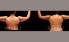 Patient 02 Back View Arm Lift Gabbay Plastic Surgery