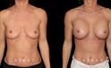 Patient breasts with silicone implants following complete recovery. Now how the incisions are hidden in the breast folds, making them invisible from most angles.
