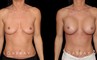 Patient breasts with silicone implants following complete recovery. Now how the incisions are hidden in the breast folds, making them invisible from most angles.
